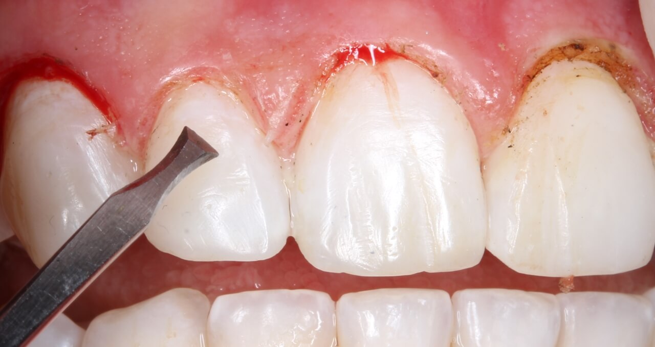 Fig. 7: Osteotomia na região do dente 12, com cinzel