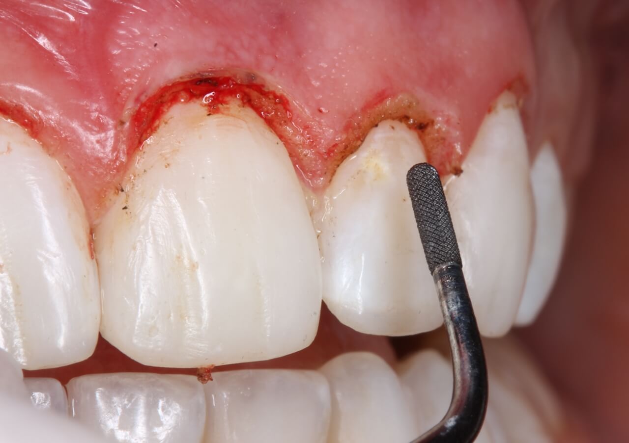 Fig. 8: Osteotomia na região do dente 22 com Piezo cirúrgico