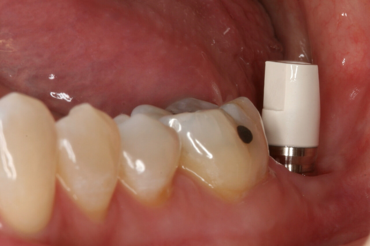Imagem do Scan Body intra oral para pilar, instalado em boca, vista lateral.