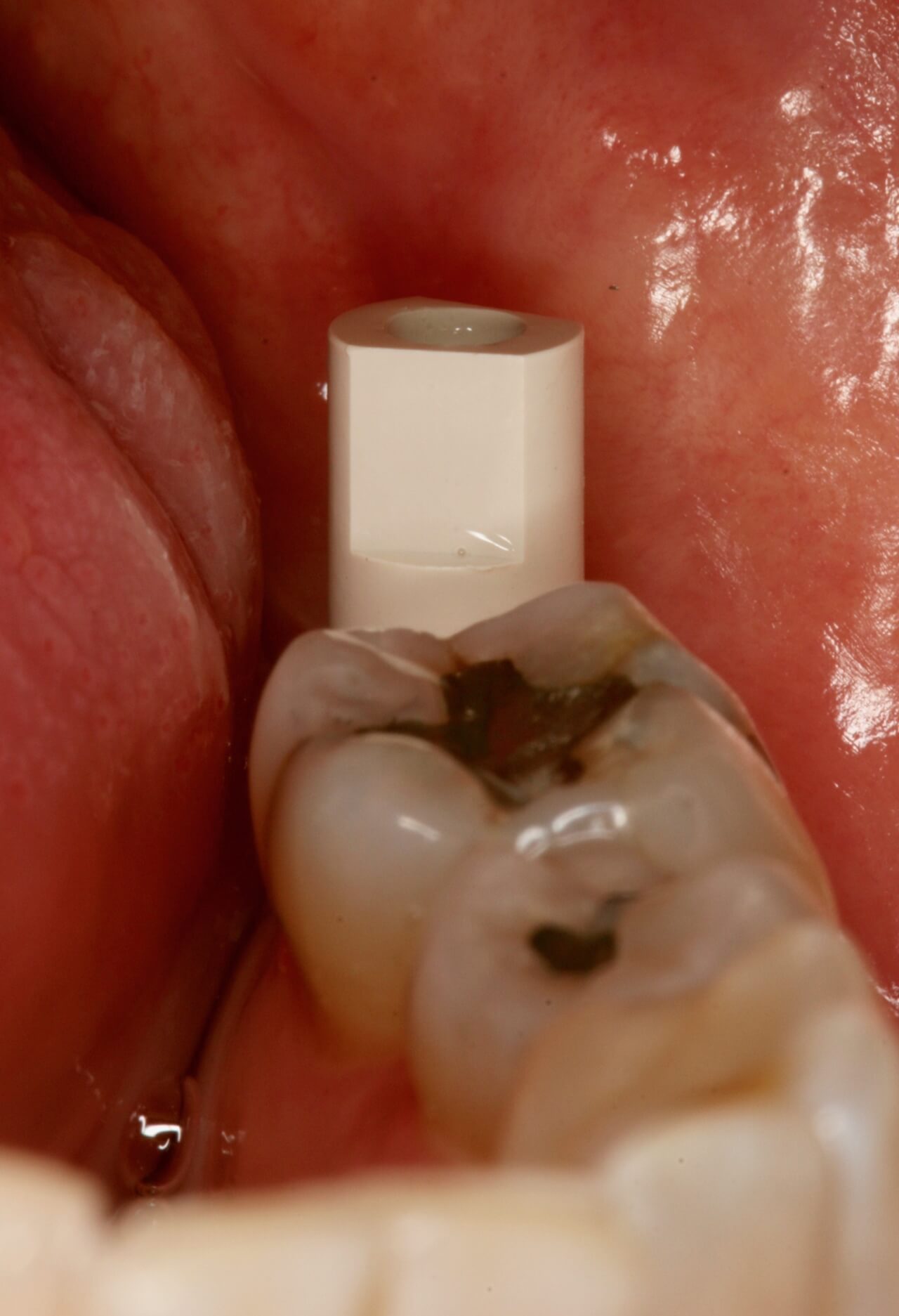Imagem do Scan Body intra oral para pilar, instalado em boca, vista anteroposterior e a relação com a mesa oclusal dos dentes adjacentes.