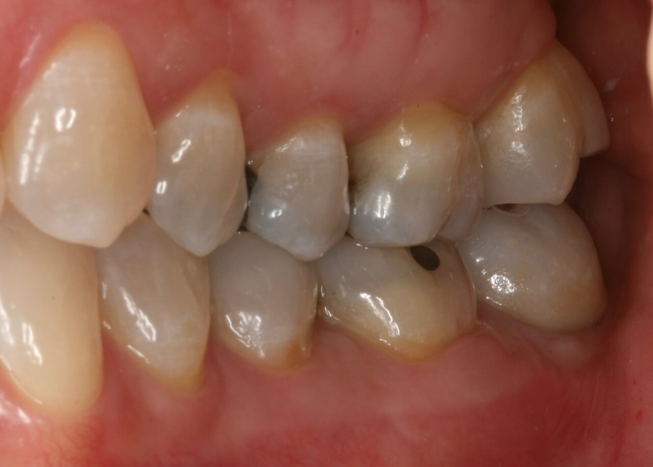 Vista lateral da coroa definitiva e sua relação com o dente adjacente e antagonista
