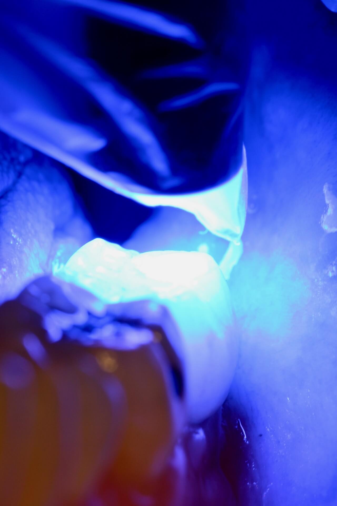 Fotopolimerização da restauração de resina para fechar o acesso do parafuso na coroa sobre implante.