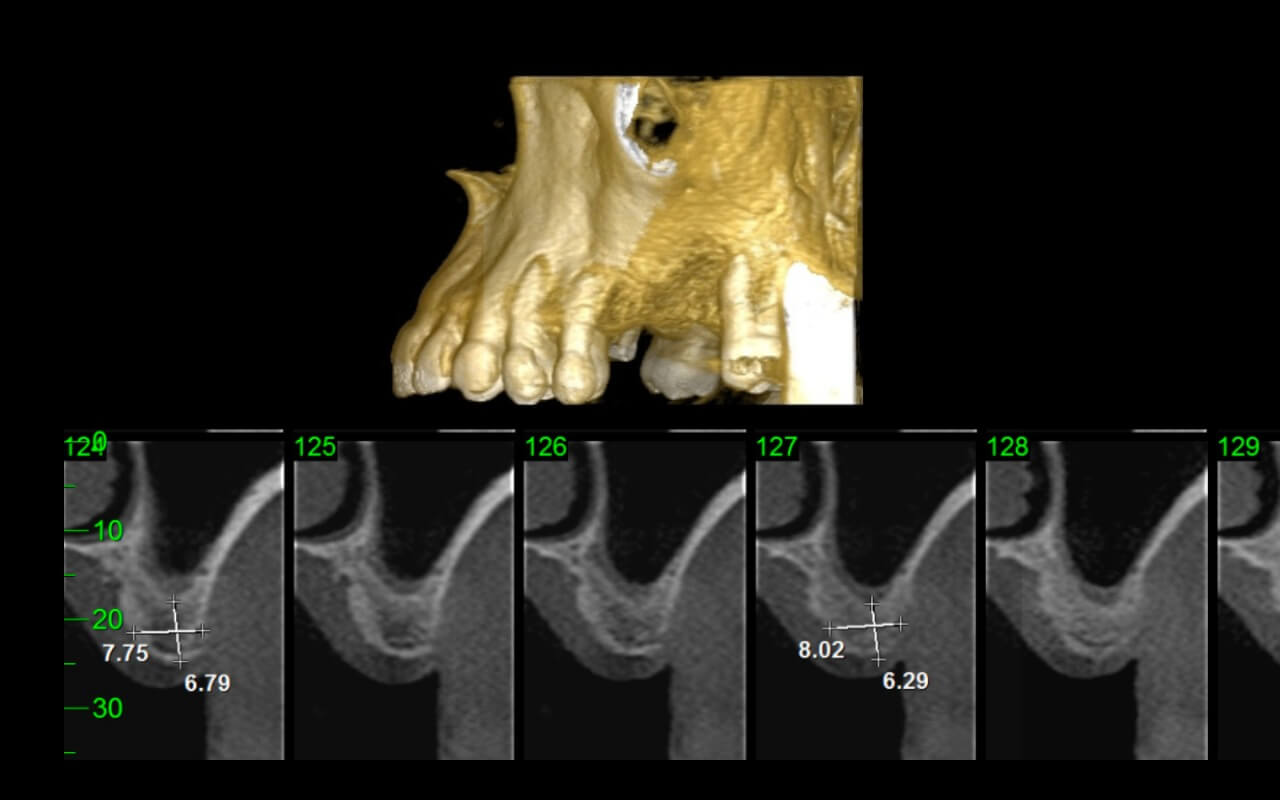 Fig. 1 – Aspecto da tomografia no pré-operatório.