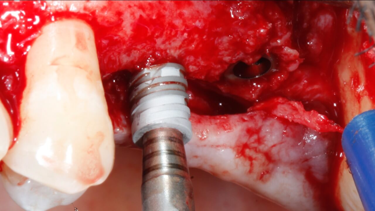 Fig. 7 – Implantes Arcsys sendo inseridos.