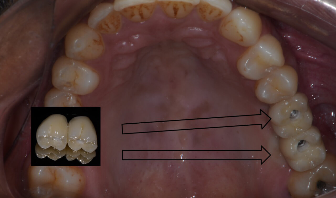Fig. 15 – Coroas sobre os implantes instalados.