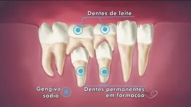 dentes de leite - O Primeiro Dente de Leite: Guia para uma Extração Segura dentes de leite - O Primeiro Dente de Leite: Guia para uma Extração Segura