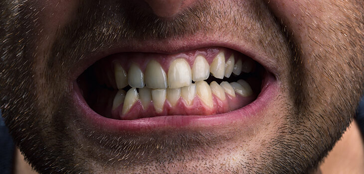 Bruxismo 746x350 1 730x350 1 - How Stress Affects Your Mouth
