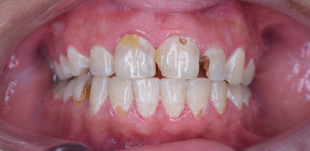 Dental decay scaled e1690908422835 - Como o estresse afeta sua boca