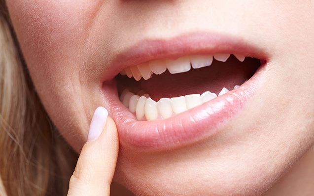 aftas - How Stress Affects Your Mouth