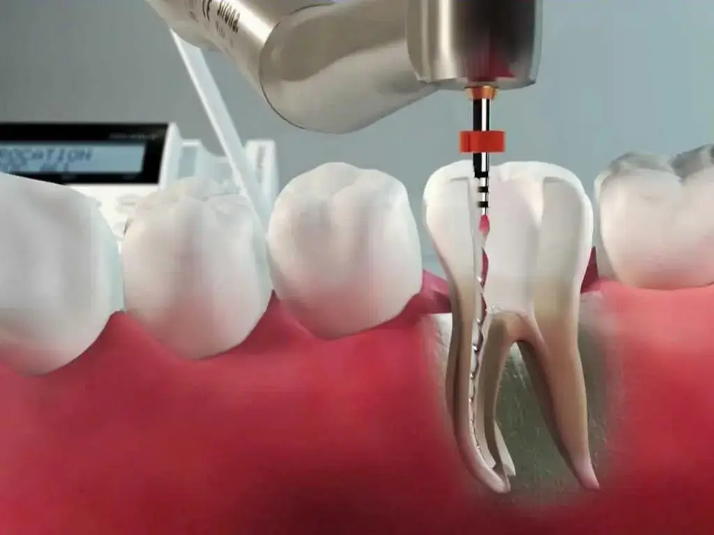 saiba como a tecnologia faz a diferenca no tratamento de canal - Teeth can have up to four canals, understand the physiology