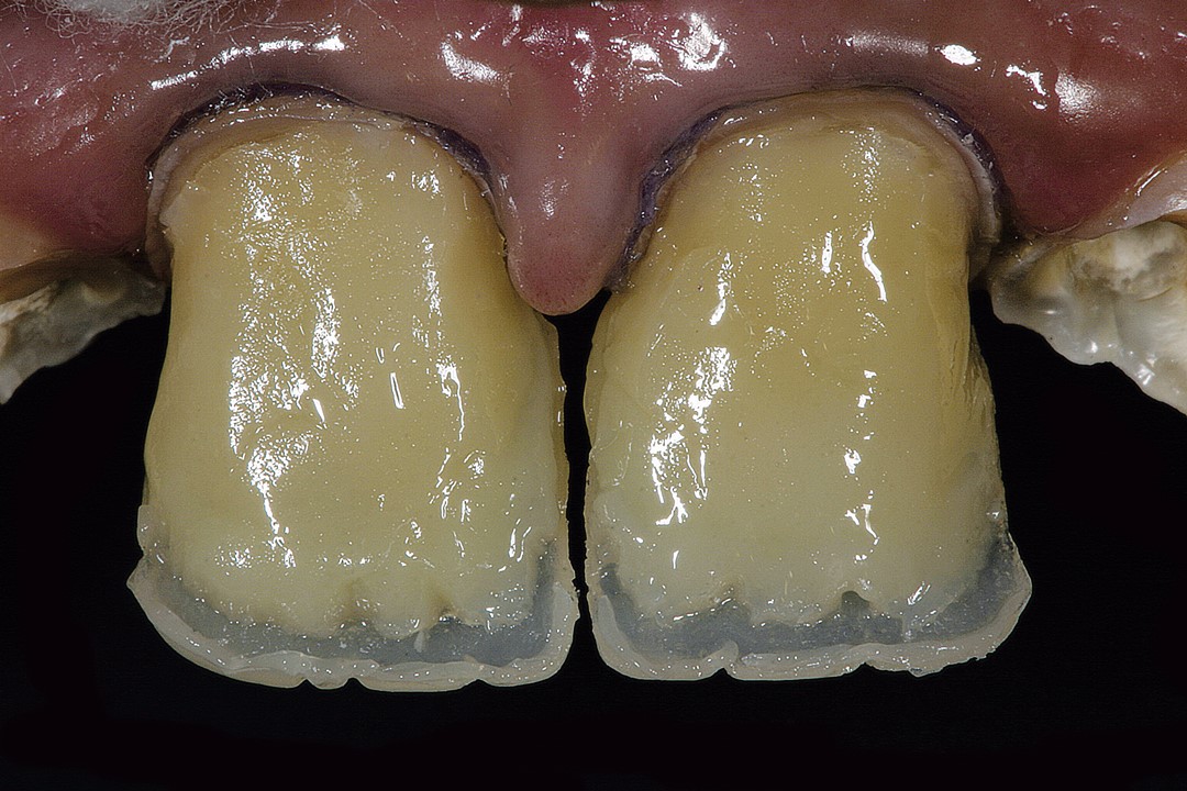 10. Aplicação das resinas de dentina A3,5 e A1 (Opallis, FGM) para confecção do halo incisal.