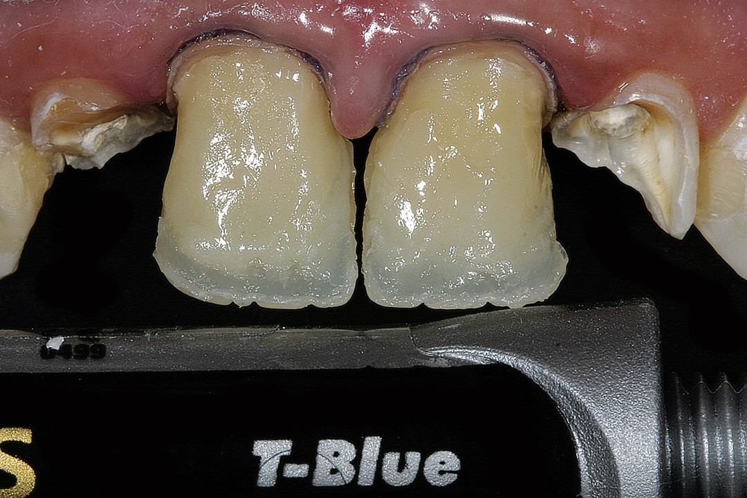 11. Aplicação da resina de efeito opalescente T-Blue (Opallis, FGM).