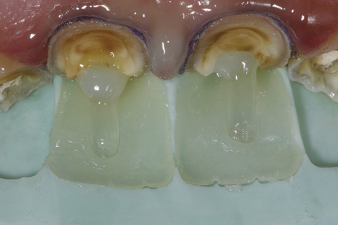 8 e 9. Início dos procedimentos restauradores. Confecção da concha palatina com a resina T-Neutral (Opallis, FGM). 