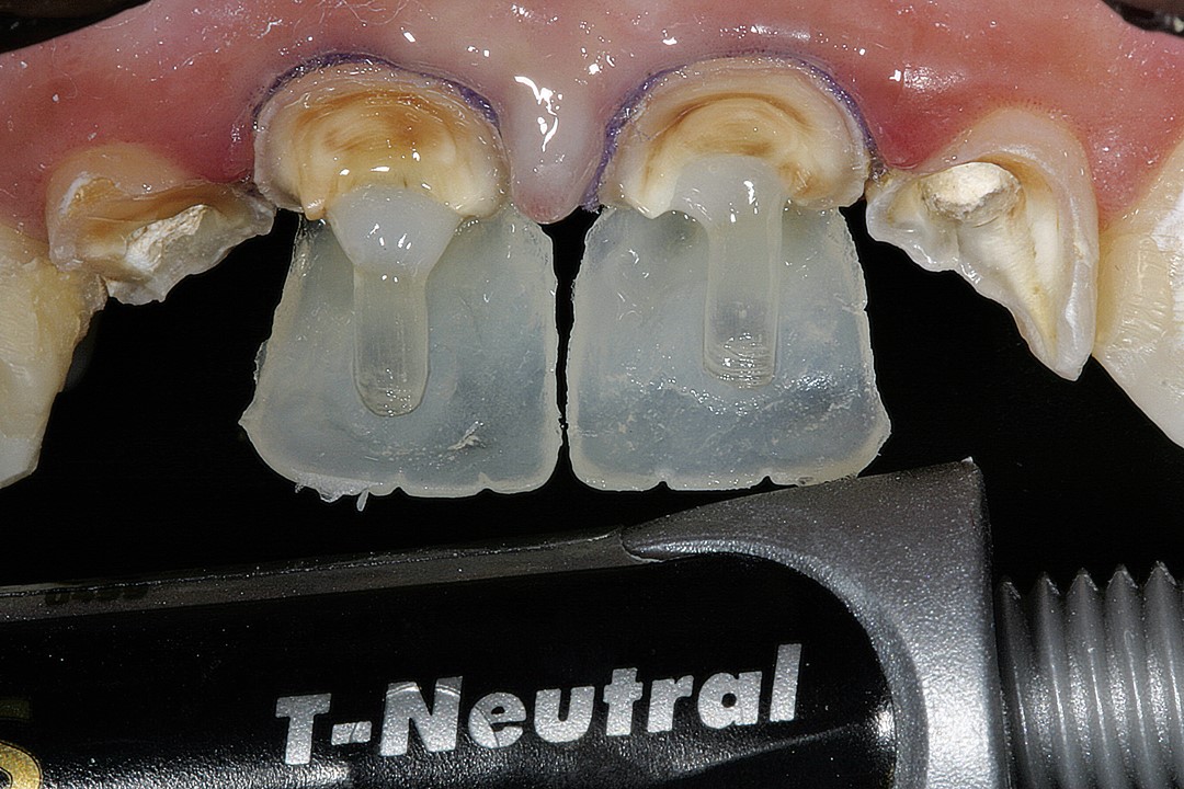 8 e 9. Início dos procedimentos restauradores. Confecção da concha palatina com a resina T-Neutral (Opallis, FGM).