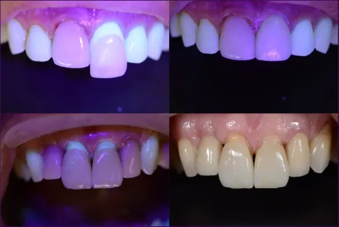 4a 4b 4c e 4d - A importância da fluorescência nas cerâmicas dentais