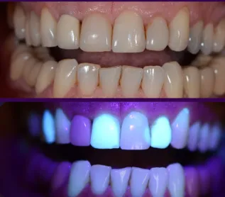 fig 1a e 1b - A importância da fluorescência nas cerâmicas dentais