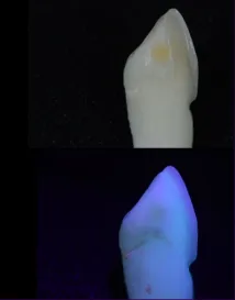 fig 2a e 2b - A importância da fluorescência nas cerâmicas dentais