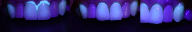 fig 6a 6b e 6c - A importância da fluorescência nas cerâmicas dentais
