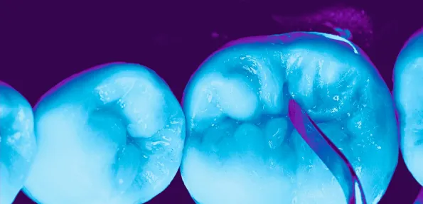 fluorescencia - A importância da fluorescência nas cerâmicas dentais