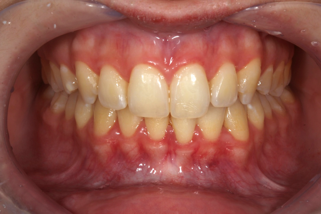 1a Dentes mostrando coloração similar a A3 e A3,5