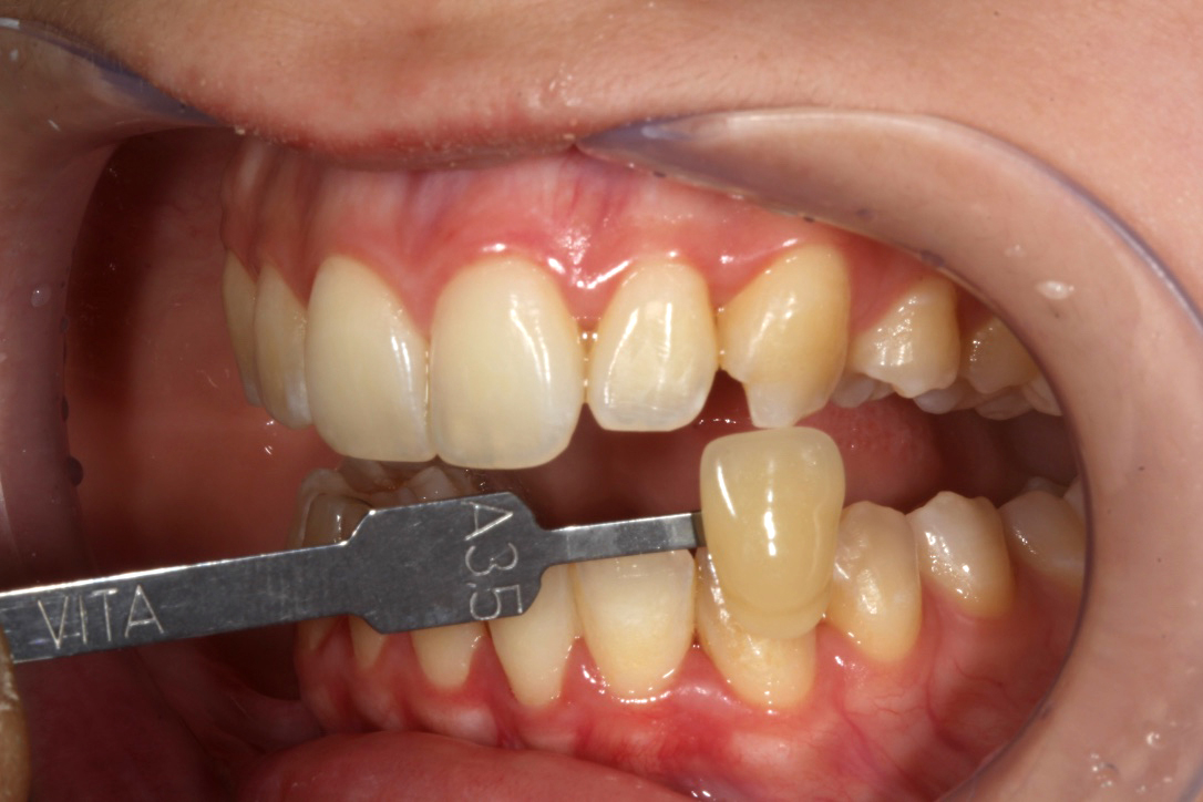 1b Dentes mostrando coloração similar a A3 e A3,5