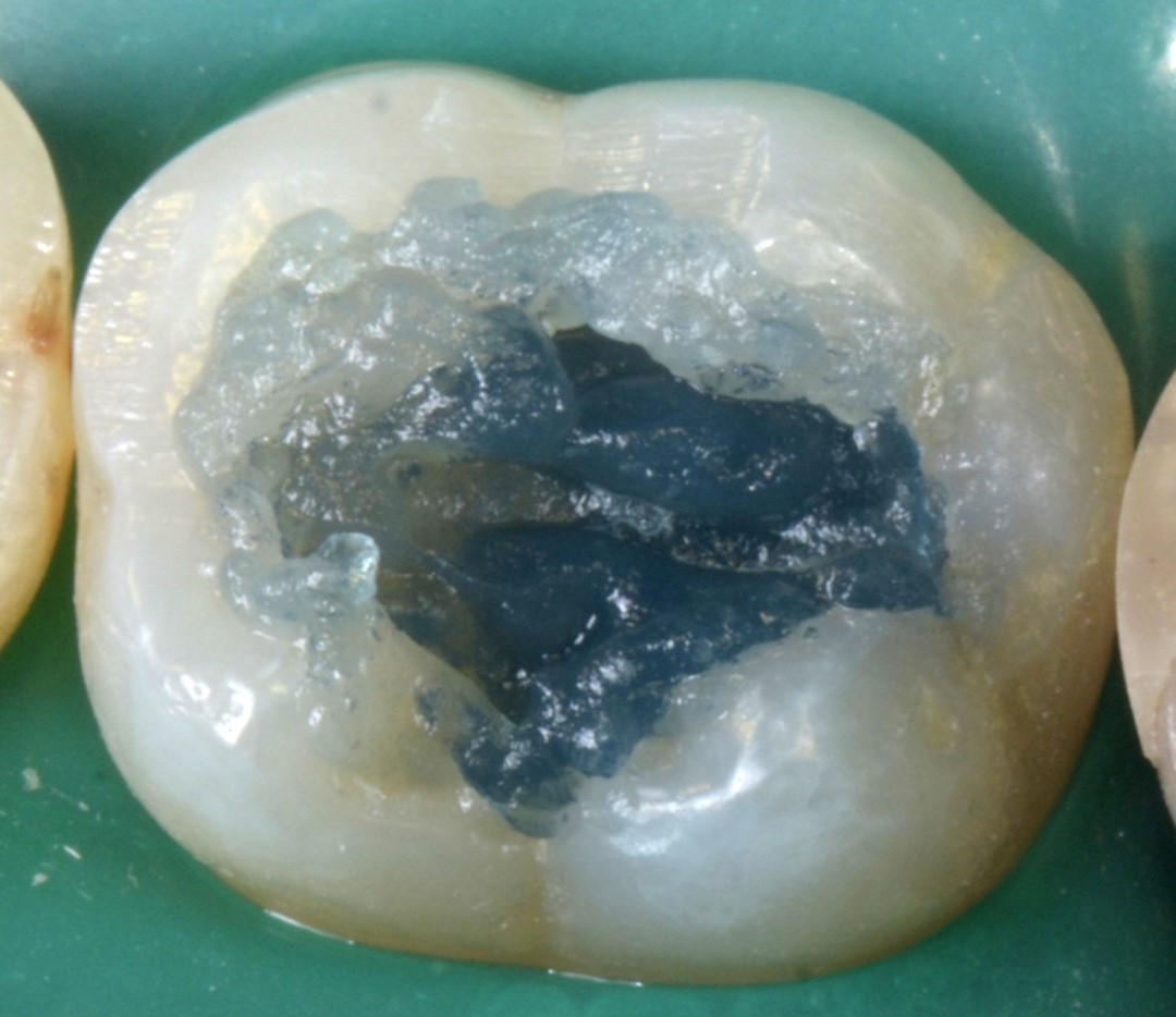 6- Condicionamento ácido de dentina por 15 segundos (Condac 37 – FGM)