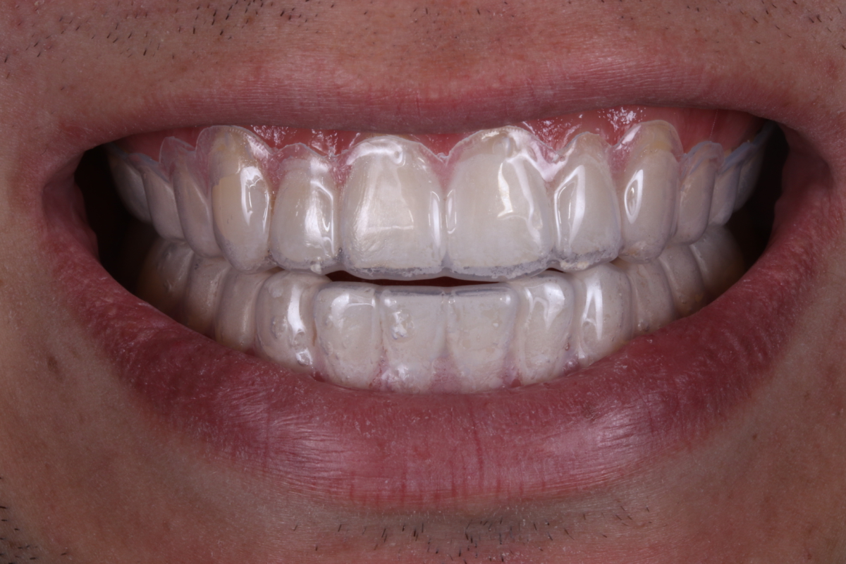 Fotografia das moldeiras superior e inferior adaptadas nos arcos dentarios