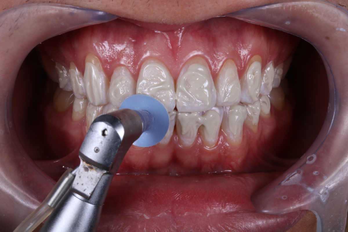 Fotografia do polimento do esmalte dentario com Diamond Flex e Diamond Excel