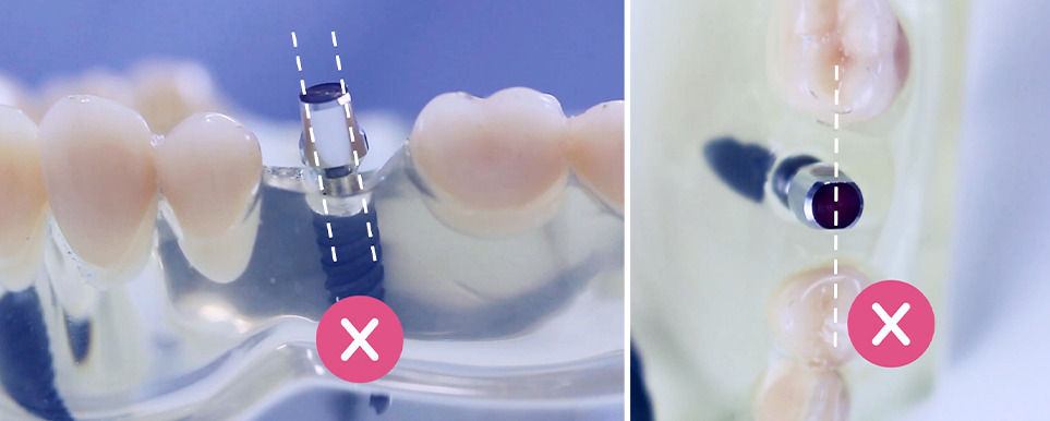Angulacao 01 - Garanta sempre a melhor posição do implante dentário e da prótese