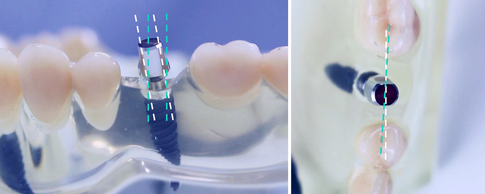 Angulacao 02 - Garanta sempre a melhor posição do implante dentário e da prótese