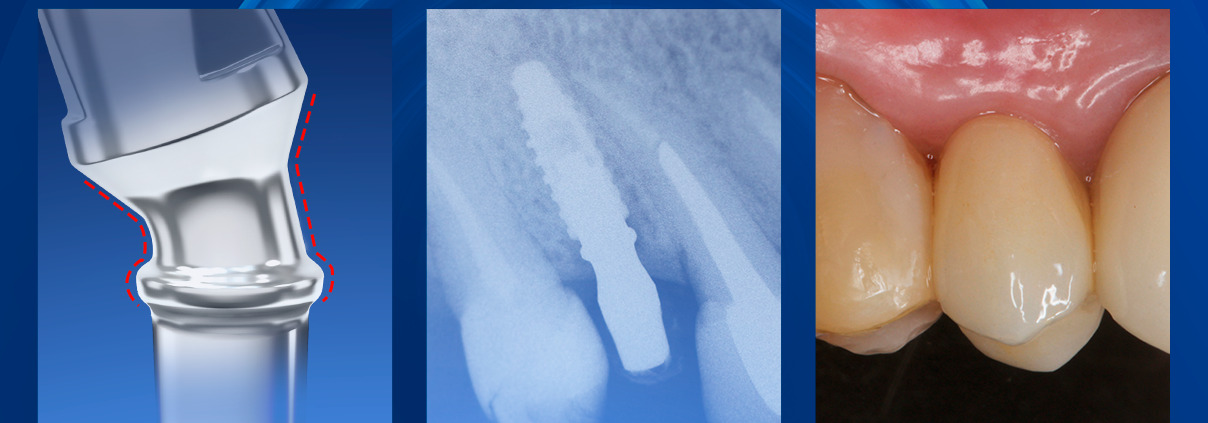 Capa Blog Arcsys 3 1208x423 1 - Garanta sempre a melhor posição do implante dentário e da prótese