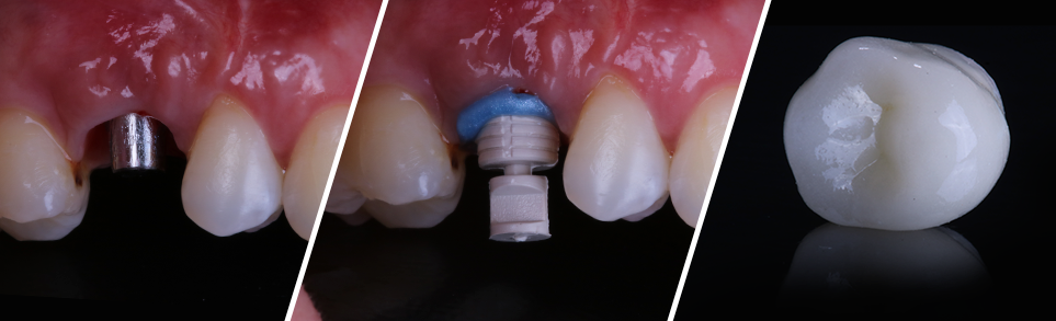 Img CC 3consultas - É possível otimizar o tempo clínico na implantodontia garantindo a qualidade no atendimento?