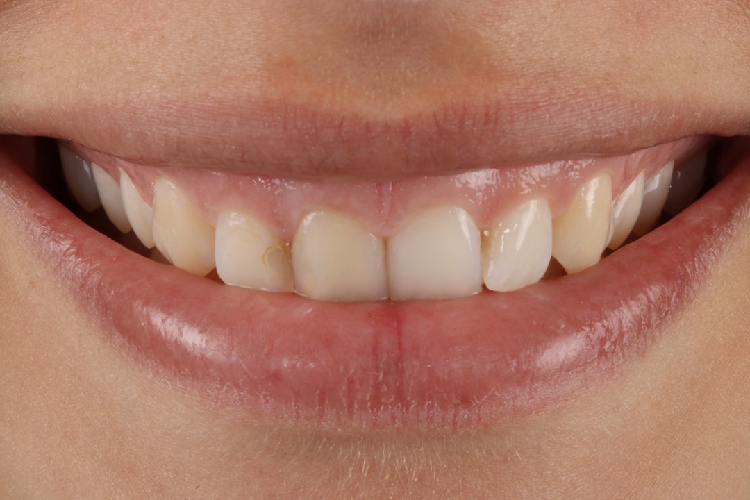 Figura 1 Aspecto inicial do sorriso da paciente, insatisfeita com a forma, tamanho e cor dos dentes