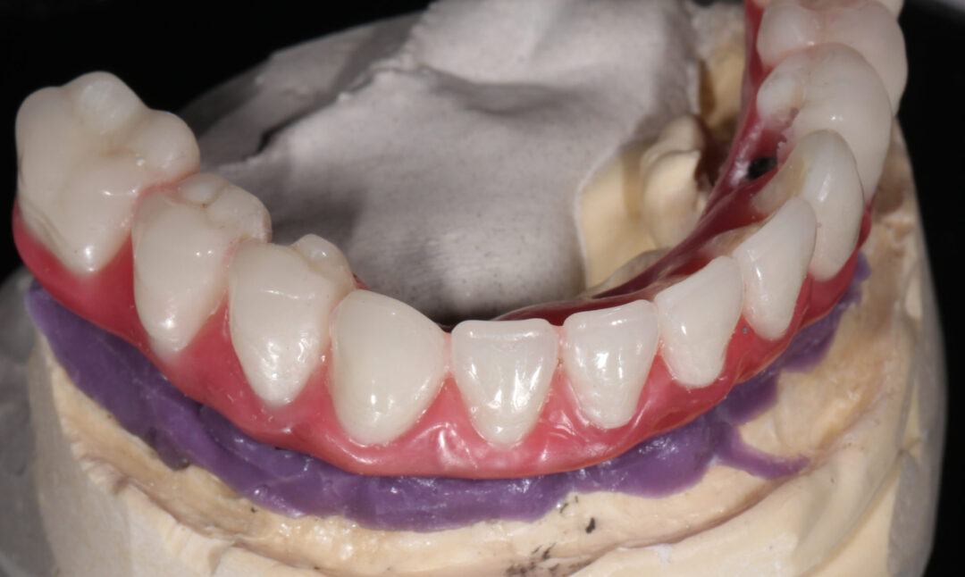 Figura 21 – Montagem para prova da estrutura metálica e dentes