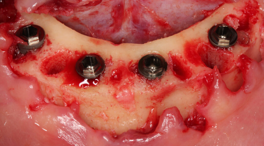 Figura 5 - Transcirúrgico após exodontias regularização do rebordo alveolar e instalação dos implantes e componentes protéticos