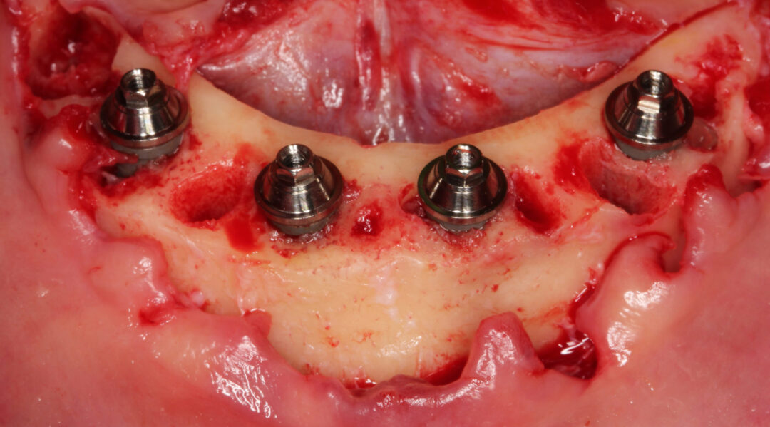 Figura 6 - Trans cirúrgico após exodontias, regularização do rebordo alveolar e instalação dos implantes e componentes protéticos