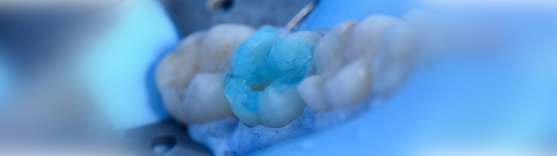 ¿Por qué utilizar el ácido fosfórico en las restauraciones dentales?