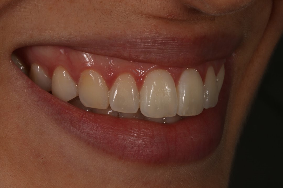 Figuras 1 A, B e C: Aspecto inicial: paciente adulta jovem insatisfeita com a cor dos dentes.