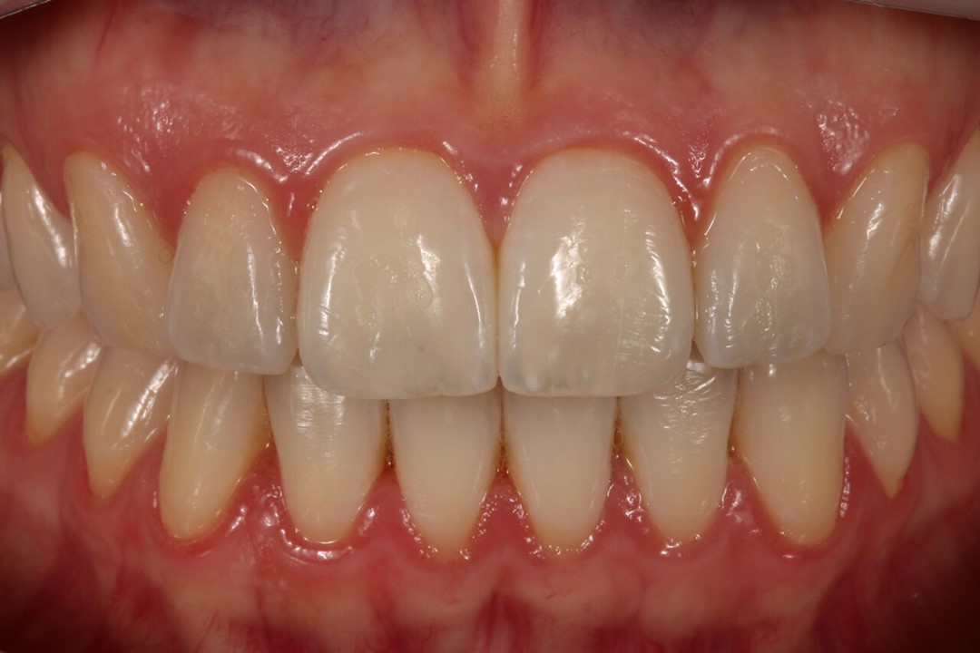 Figuras 1 D e E: Pormenor dos dentes anteriores.