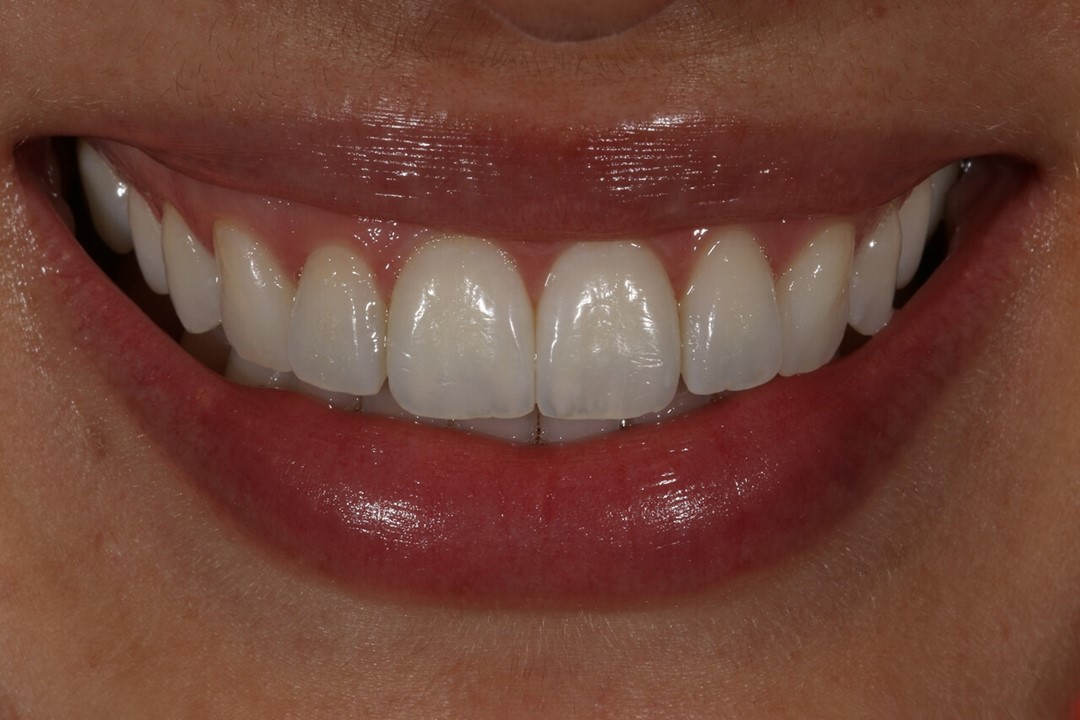 Figuras 2 A, B e C: Aspecto final do sorriso da paciente.
