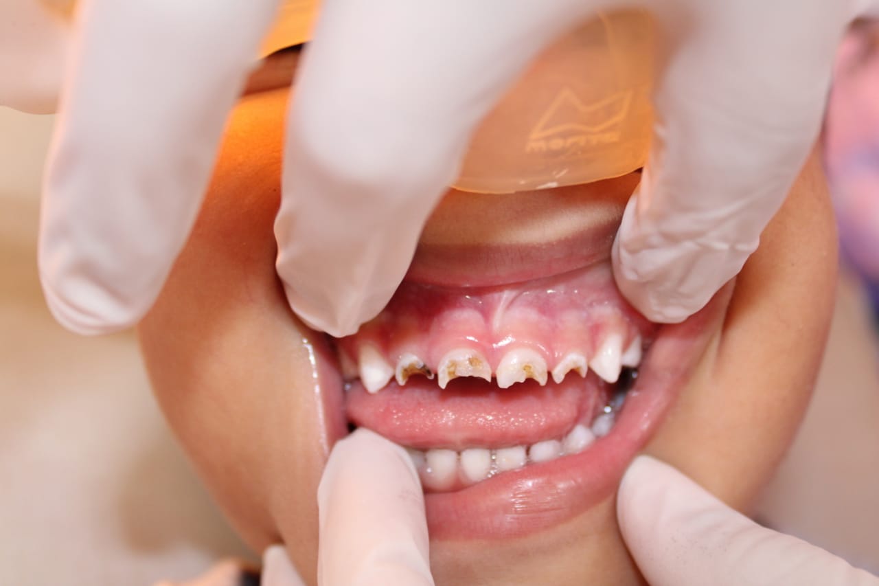 Figura 3 - Foto inicial, um desafio na odontopediatria