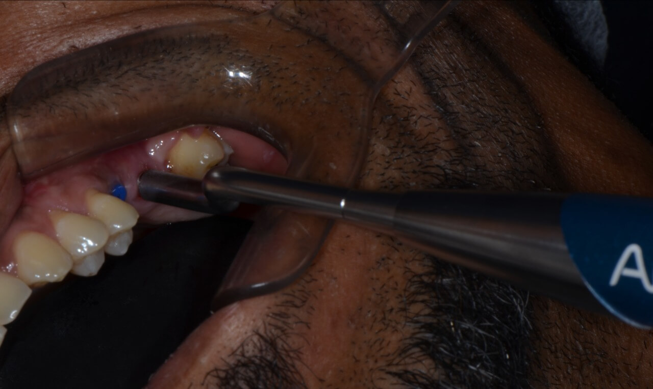 11 - Maxilary sinus lift with the concomitant installation of implants: clinical case report
