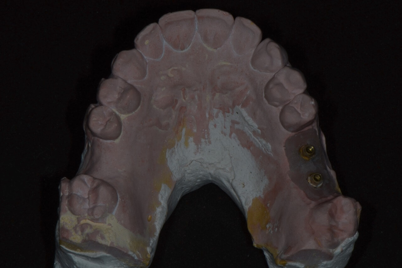 13 - Maxilary sinus lift with the concomitant installation of implants: clinical case report
