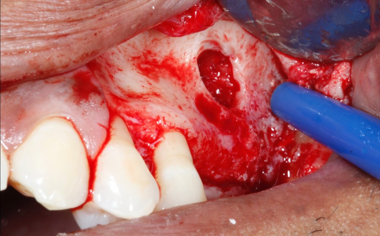 3 - Maxilary sinus lift with the concomitant installation of implants: clinical case report