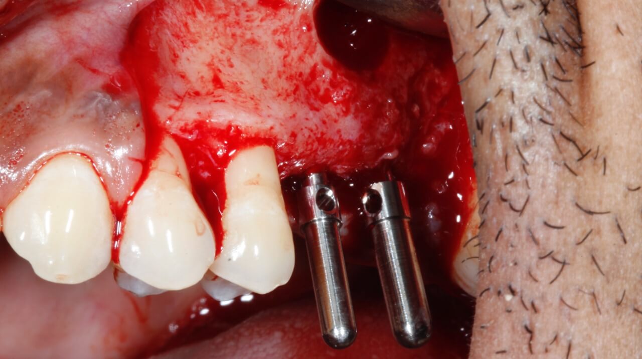 5 - Maxilary sinus lift with the concomitant installation of implants: clinical case report
