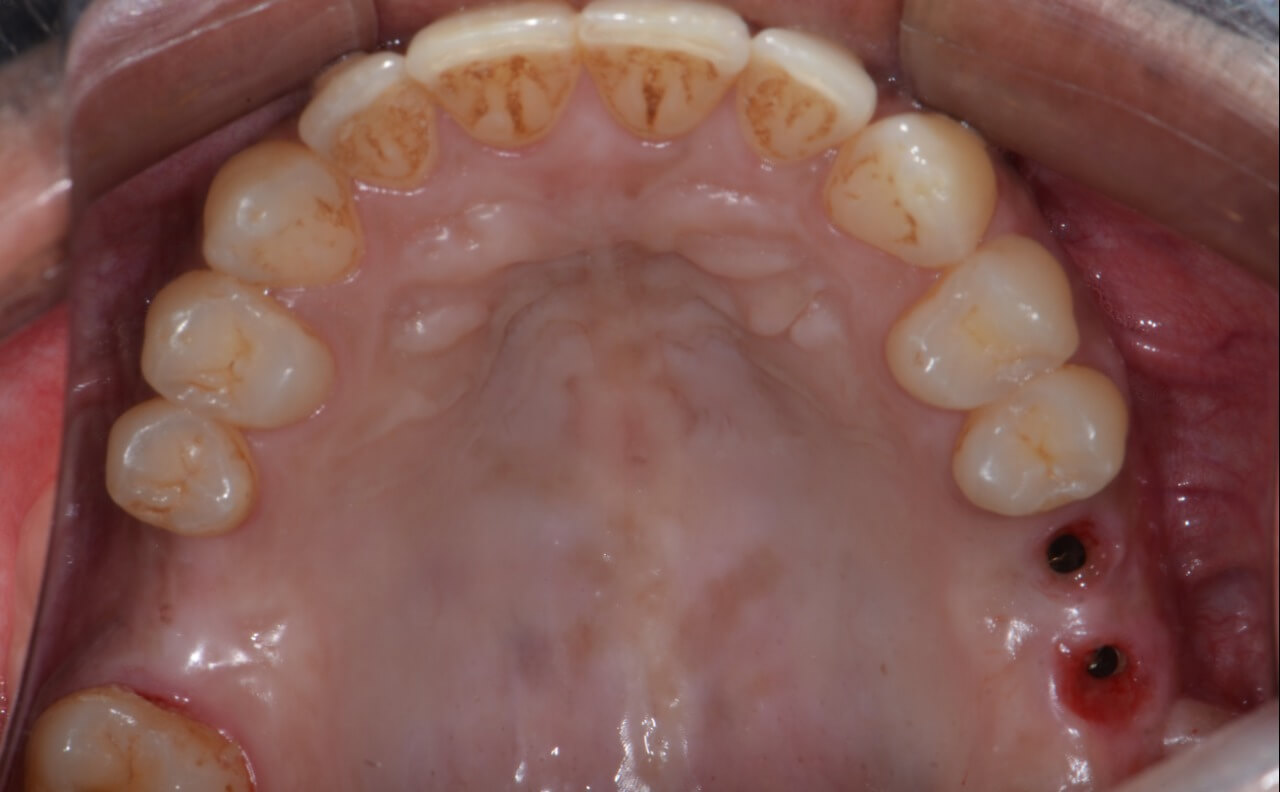 9 - Maxilary sinus lift with the concomitant installation of implants: clinical case report