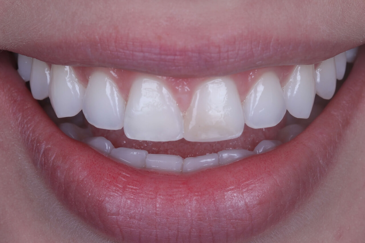 Fig. 3 - Ensaio restaurador do dente 11, mostrando que não há necessidade de maior desgaste. Foram utilizadas Vittra APS DA0, DA1 e E-Bleach.