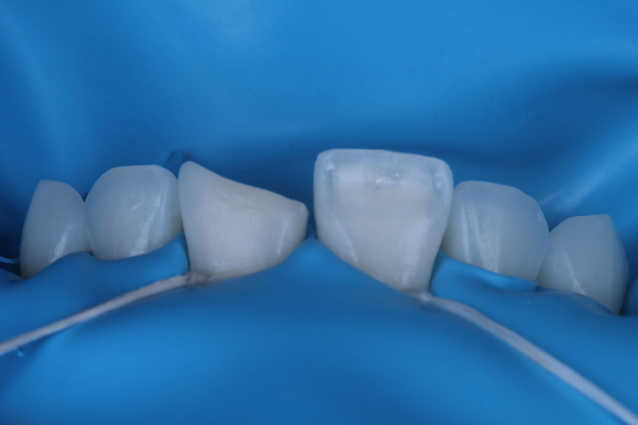 Fig. 4 - Preparo do dente 21 e isolamento