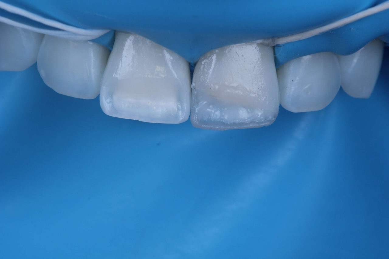 Fig. 8a - Resina de corpo Vittra APS DA1 cobrindo bisel nos dentes 11 e 21