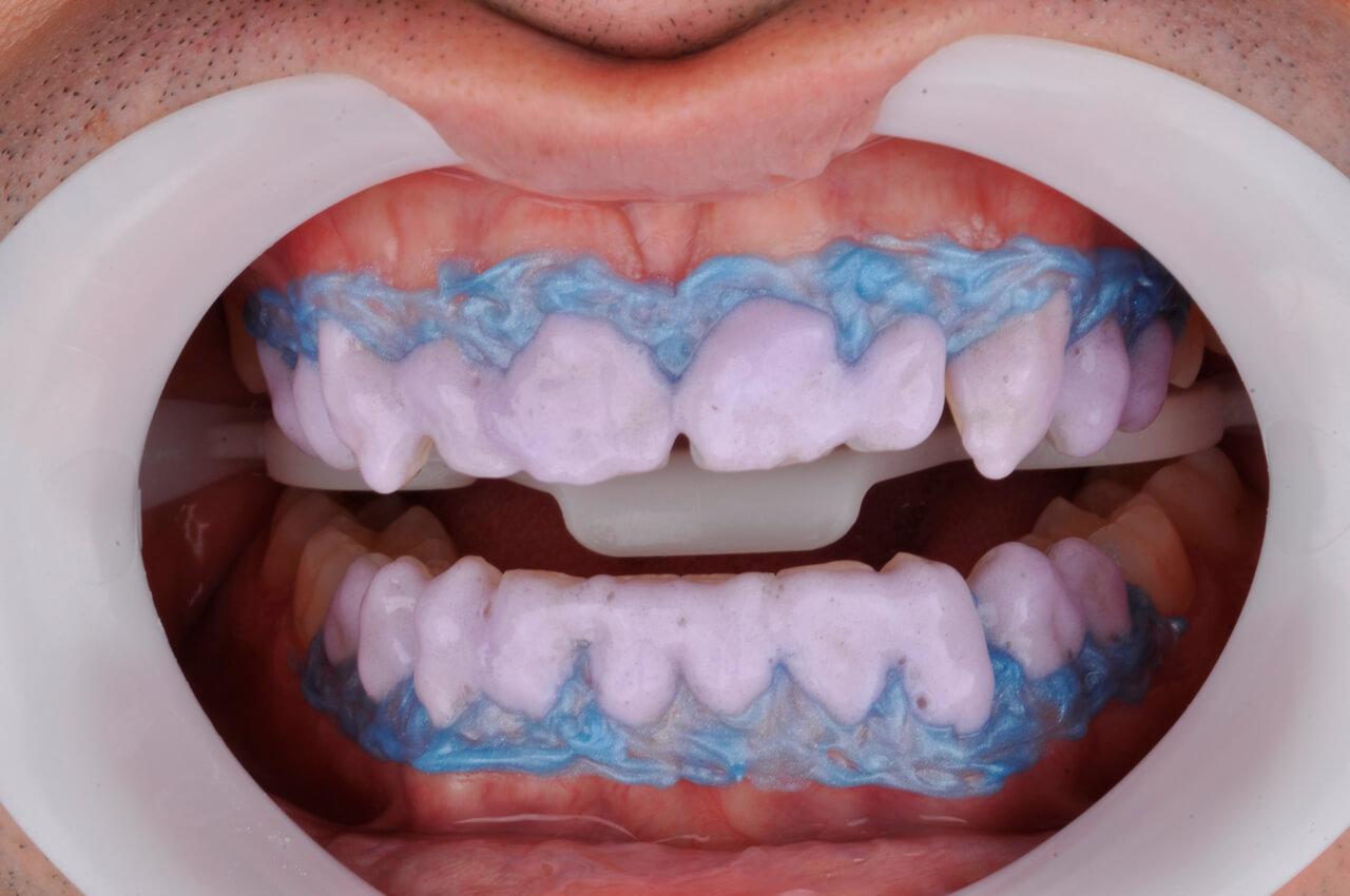Fig. 4 - Clareamento dental – Whiteness HP Blue.